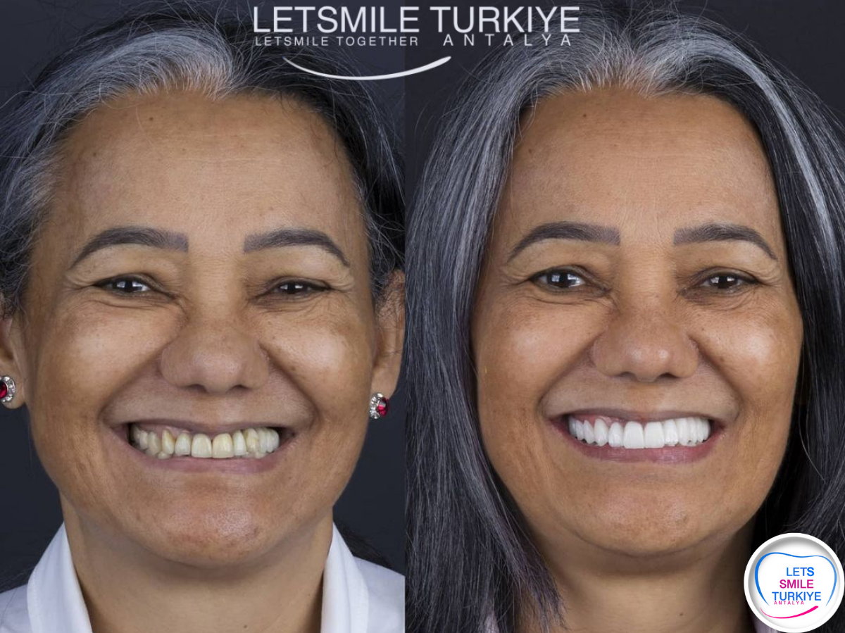 BEFORE & AFTER Before After Dental