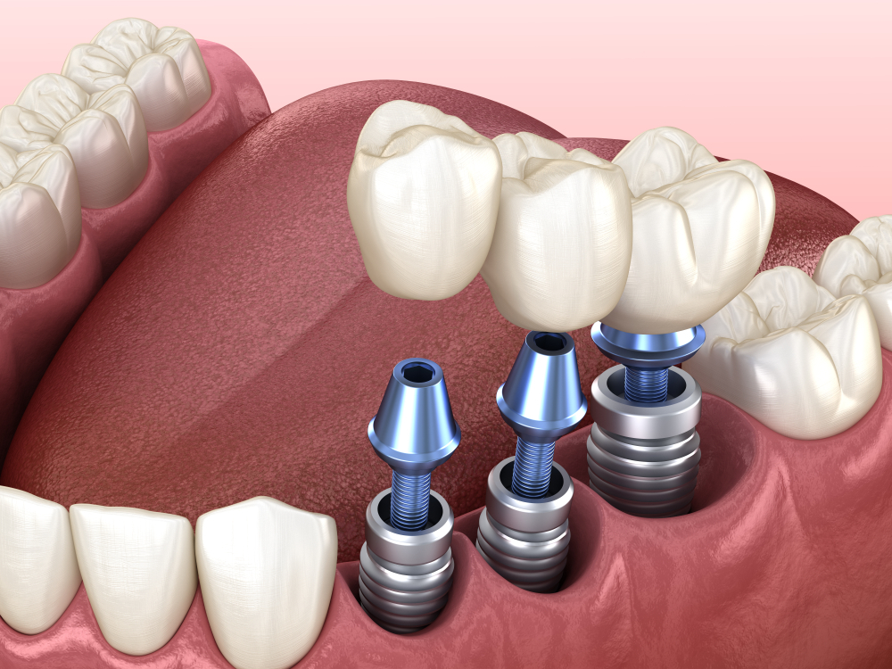 DENTAL IMPLANTS Dental Implants
