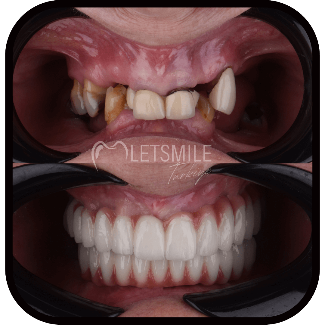 ALL ON FOUR TREATMENT SYSTEM smile makeover