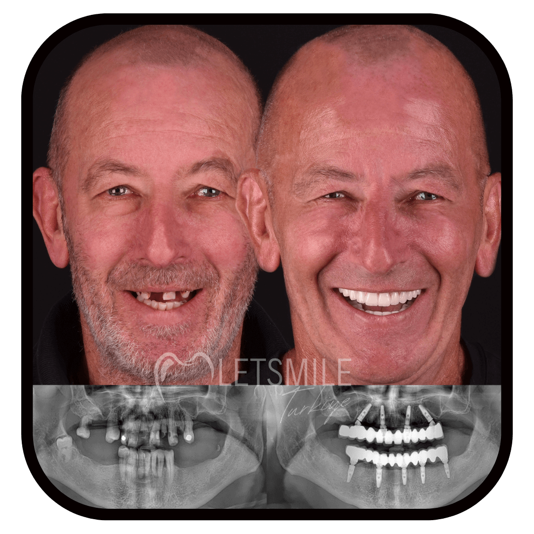 ALL ON SIX TREATMENT SYSTEM smile makeover
