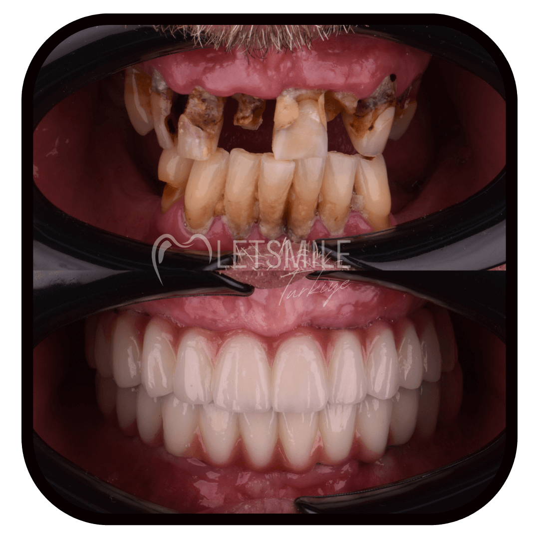 ALL ON SIX TREATMENT SYSTEM smile makeover