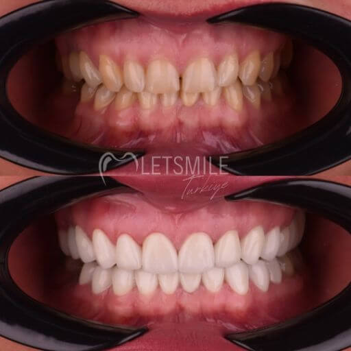 BEFORE & AFTER Before After Dental