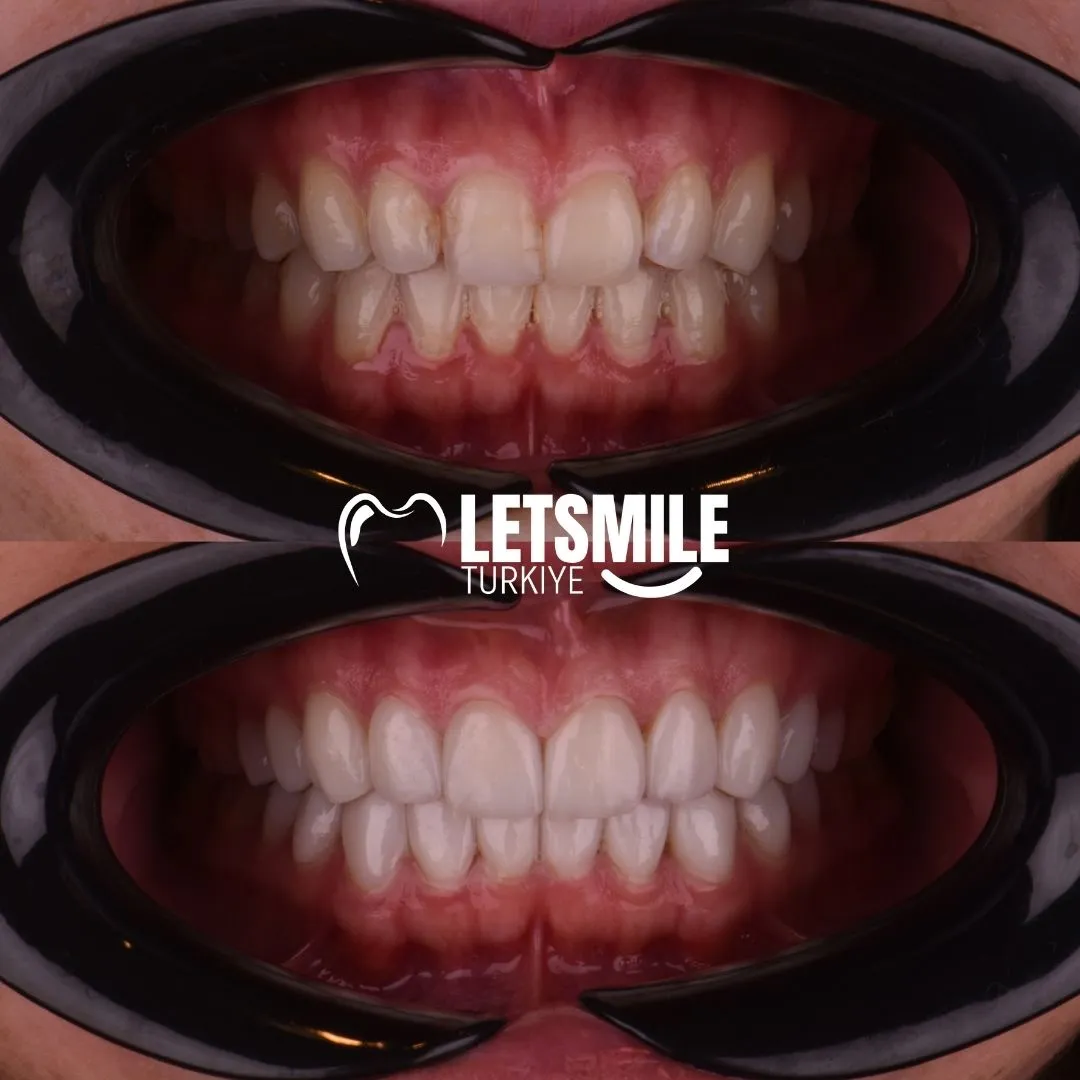 turkey teeth before and after pictures 2025