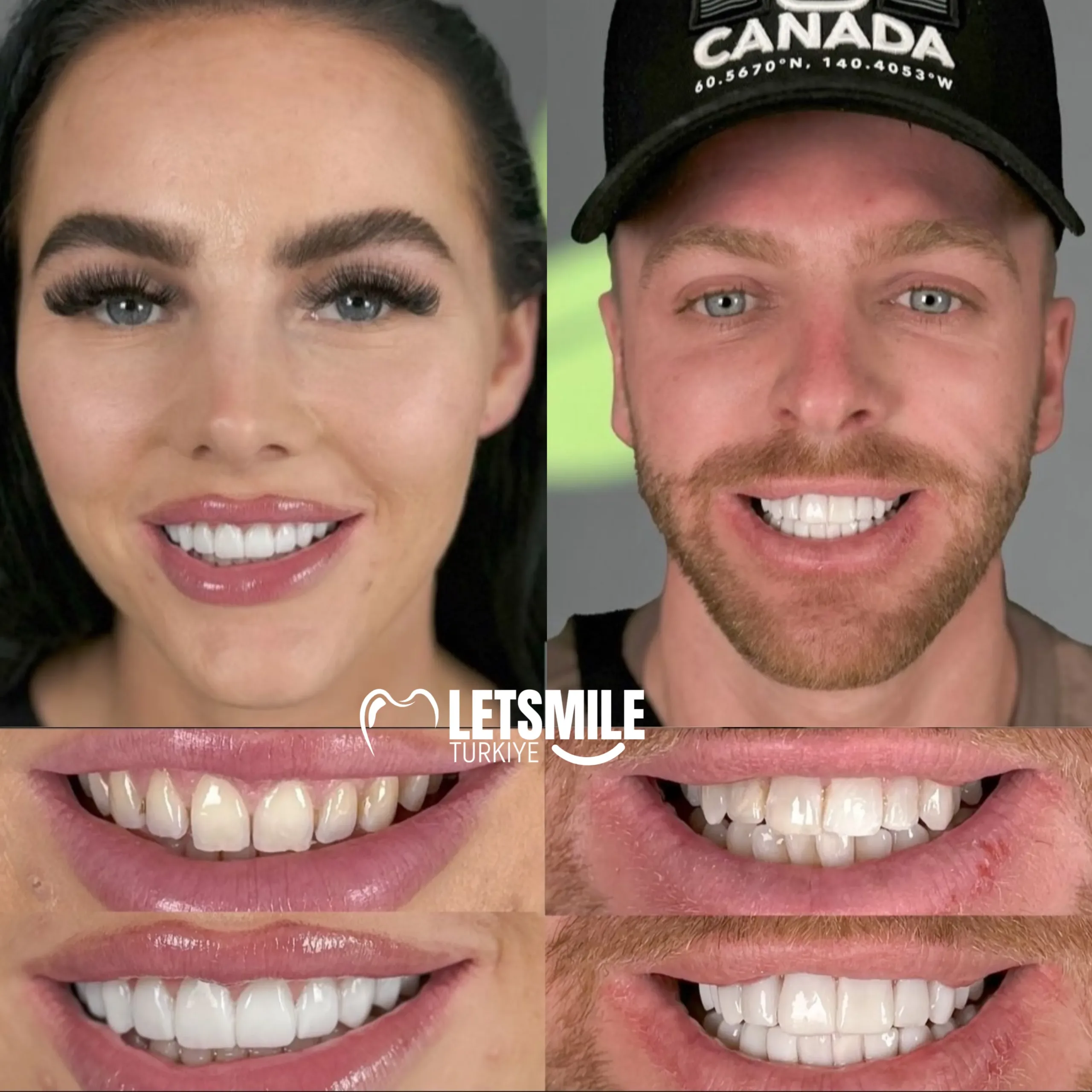 composite bonding cost in turkey