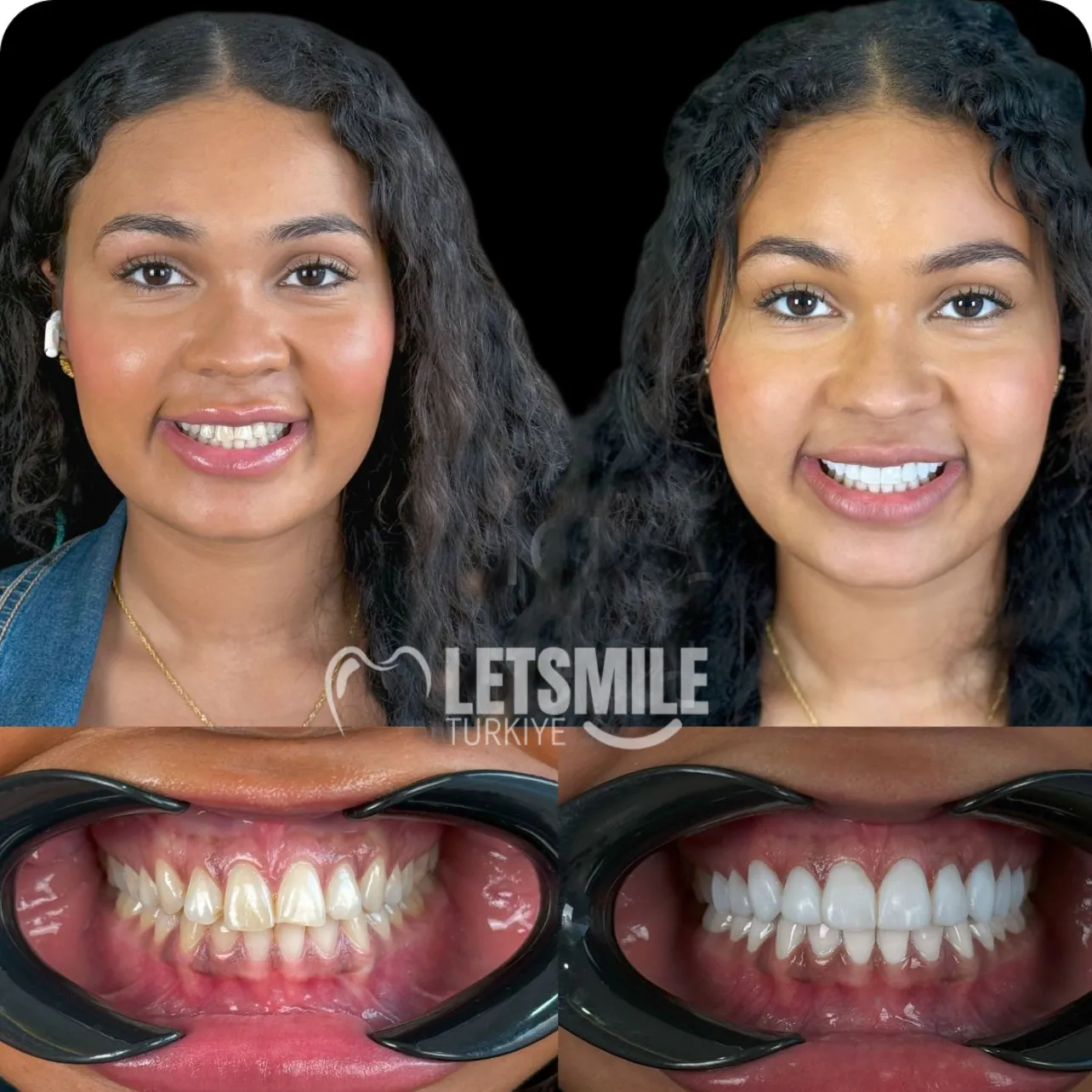 turkey teeth before and after pictures 2025