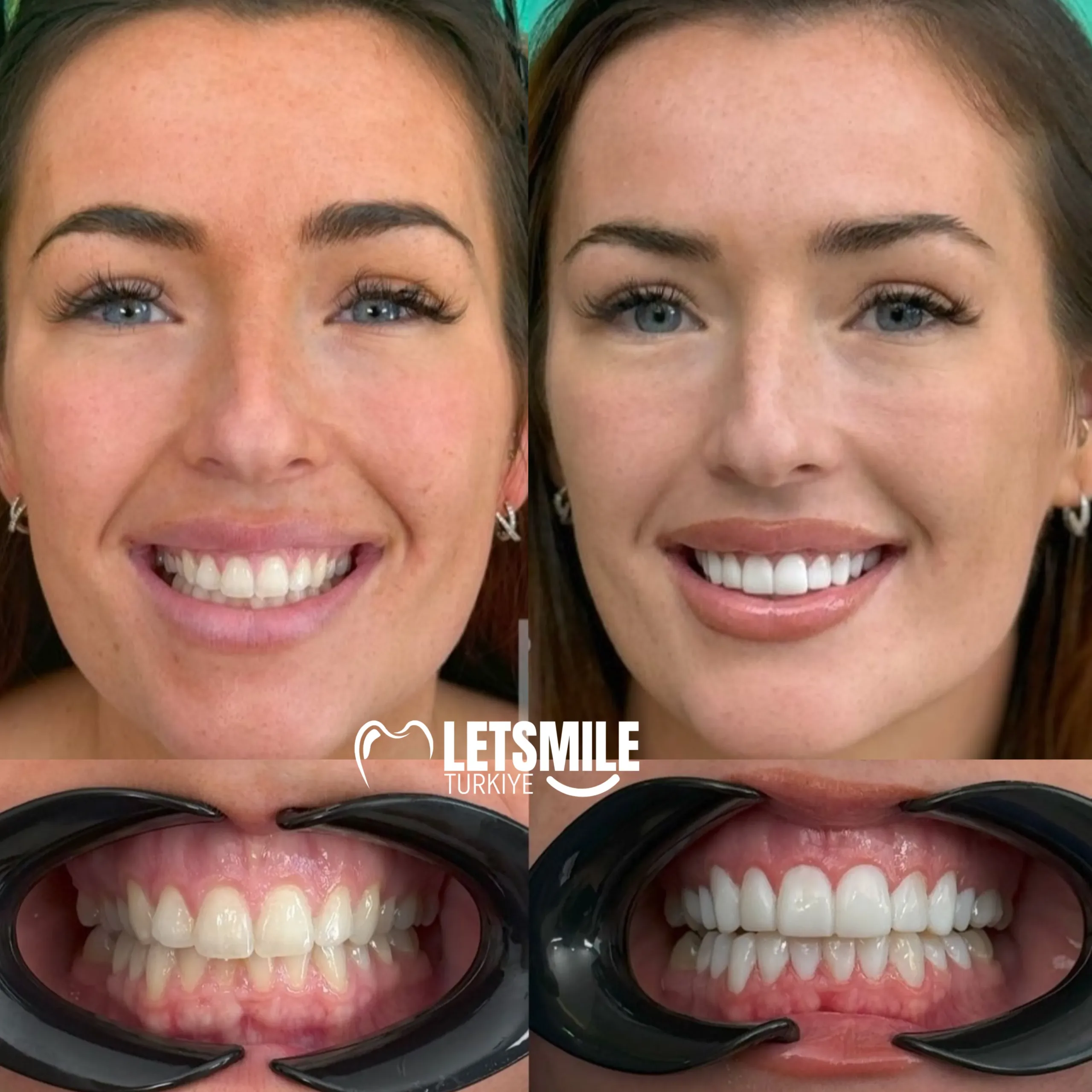 composite bonding turkey antalya price, procedure, cost