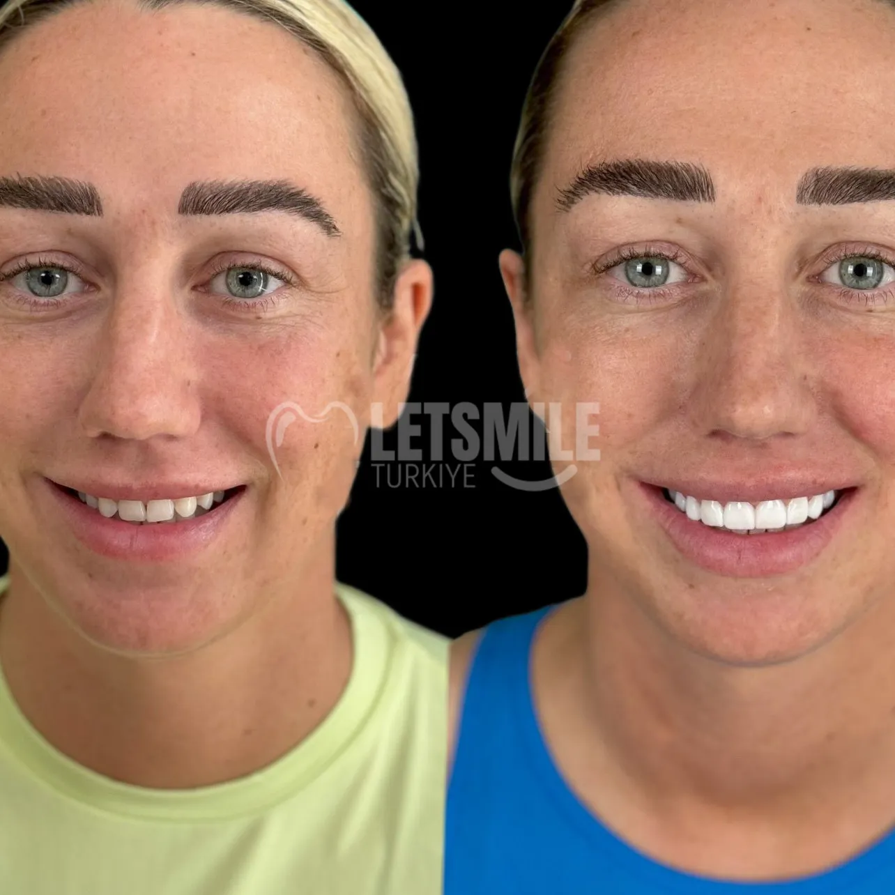 composite bonding in turkey price