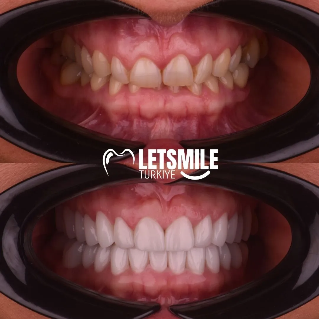 turkey teeth before and after pictures 2025