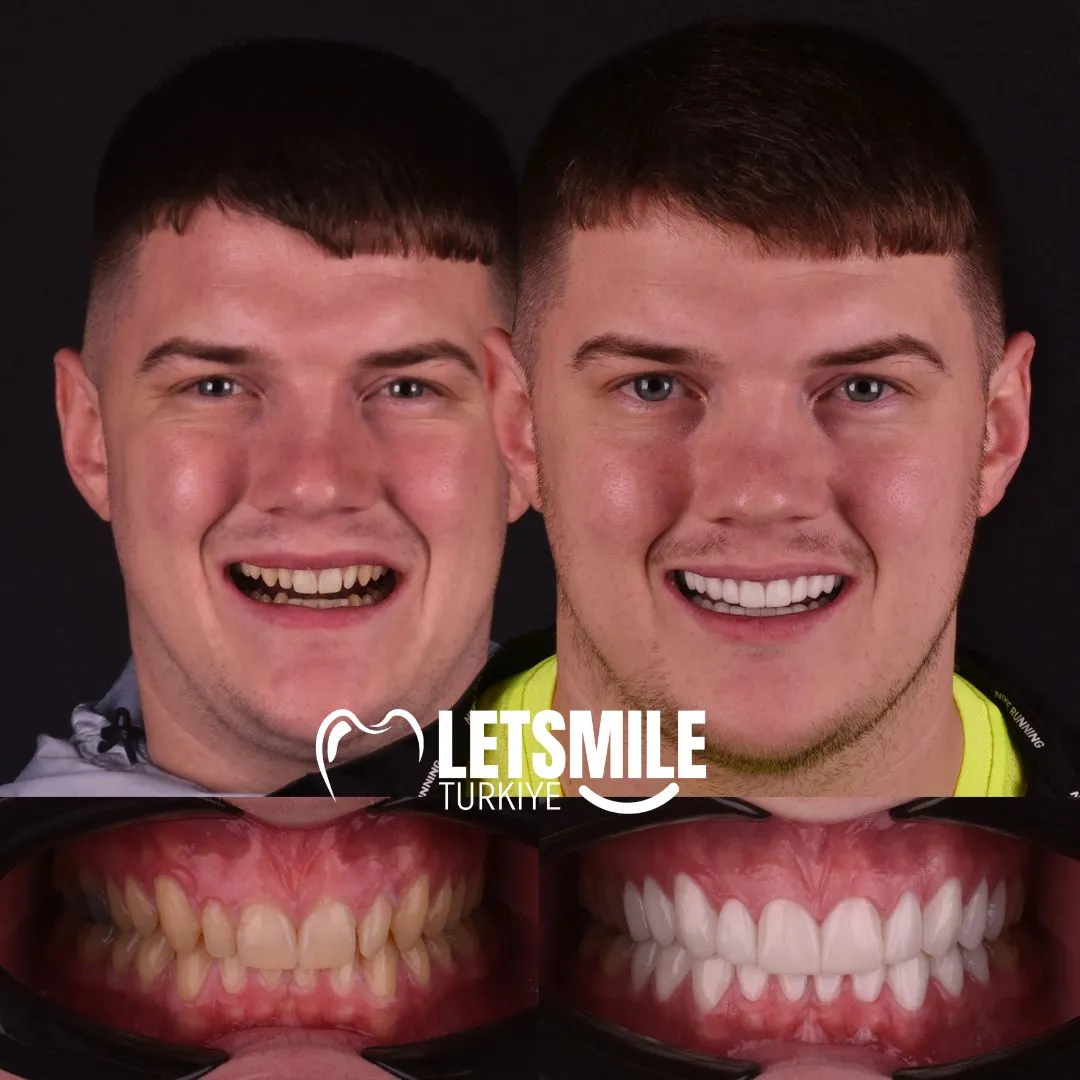 emax crowns in turkey antalya