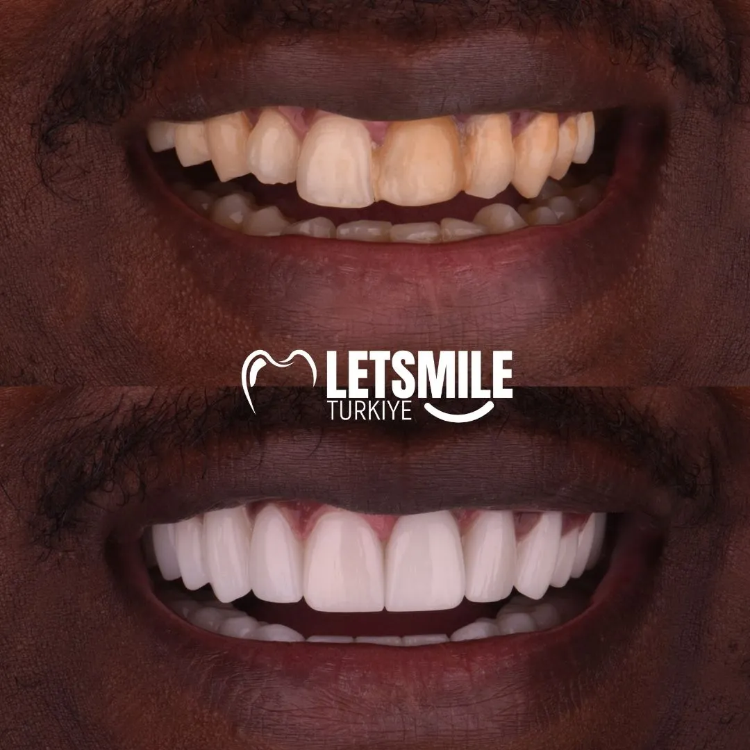 emax lamianate veneers in antalya turkey
