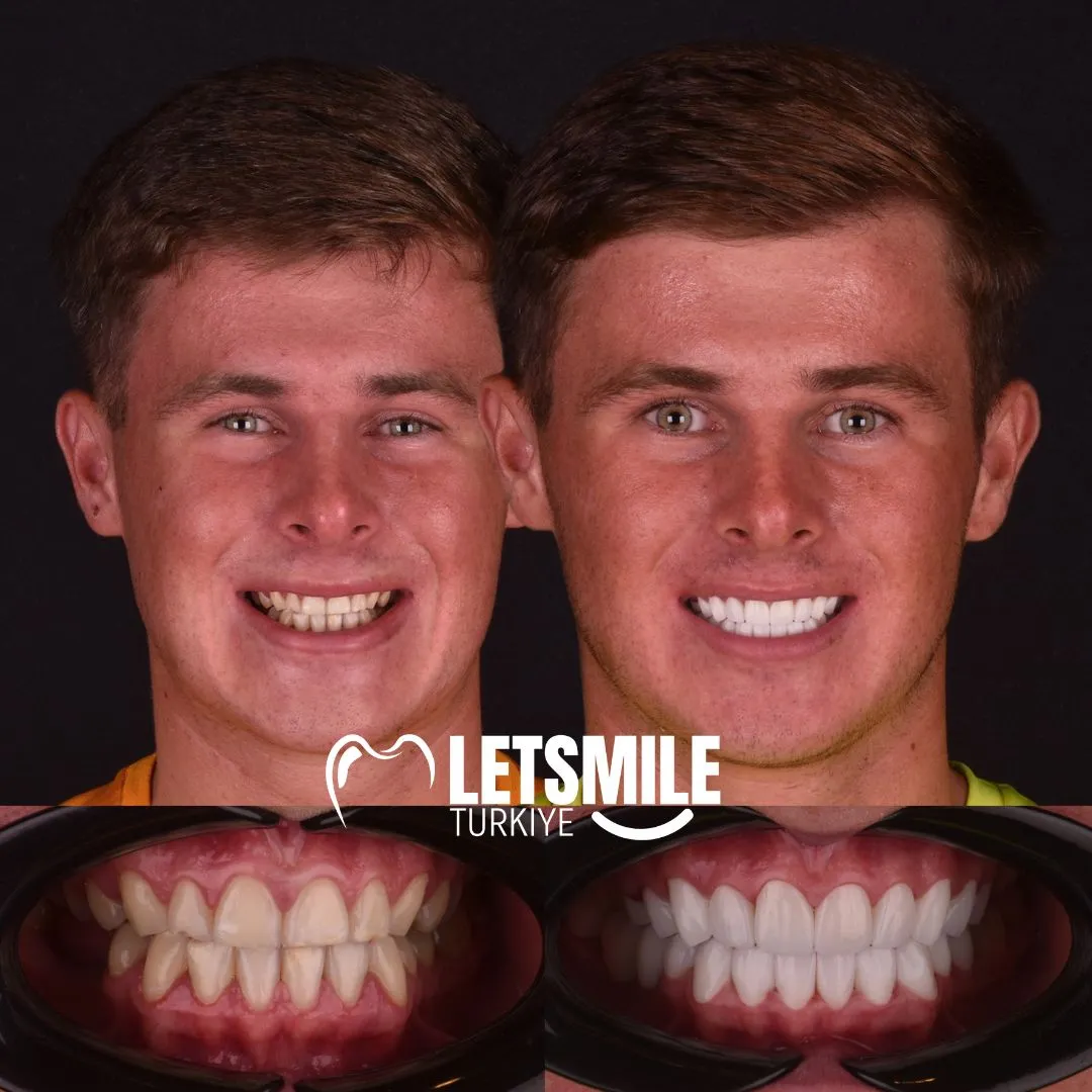 emax veneers cost in antalya turkiye