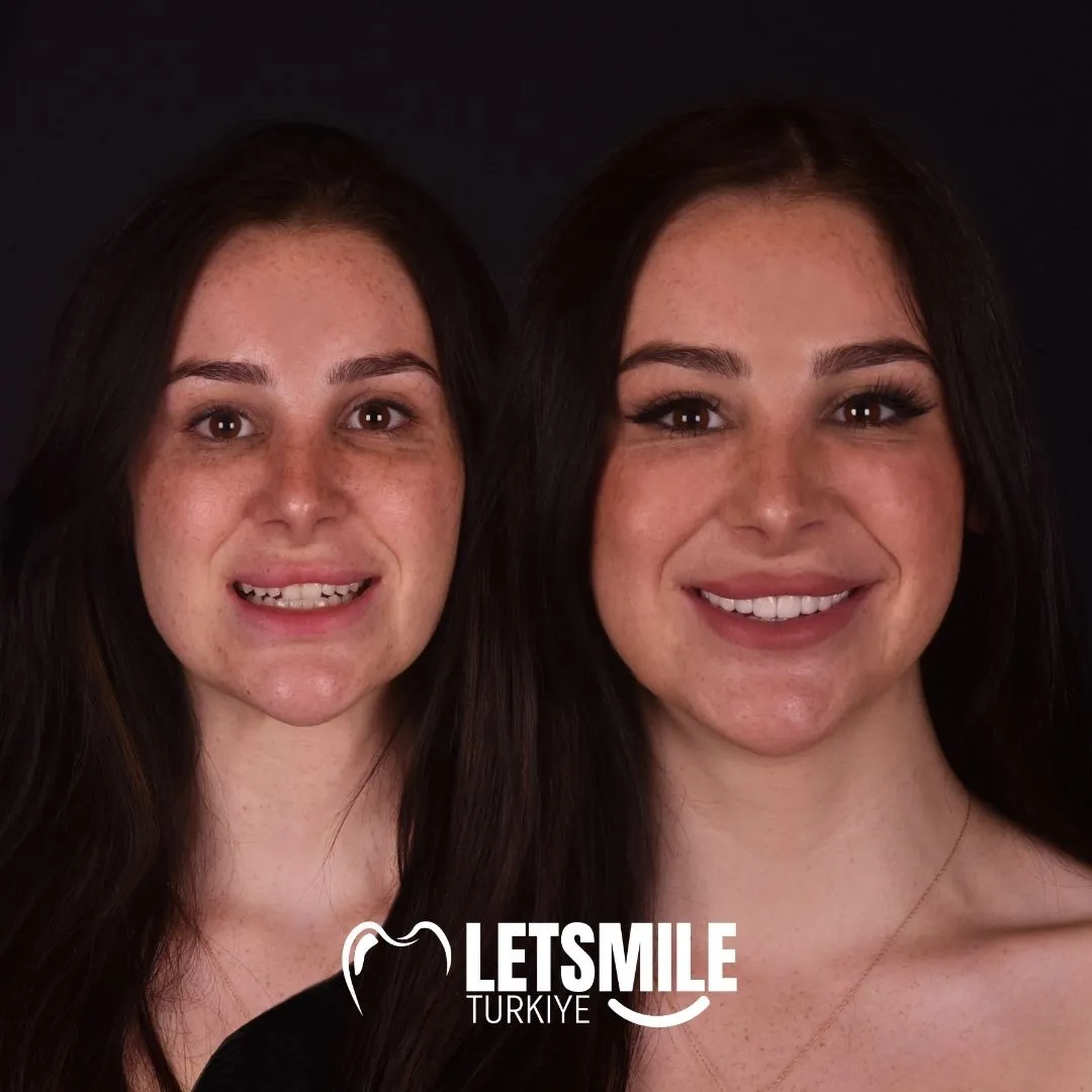 emax veneers teeth done in turkey antalya price cost procedure