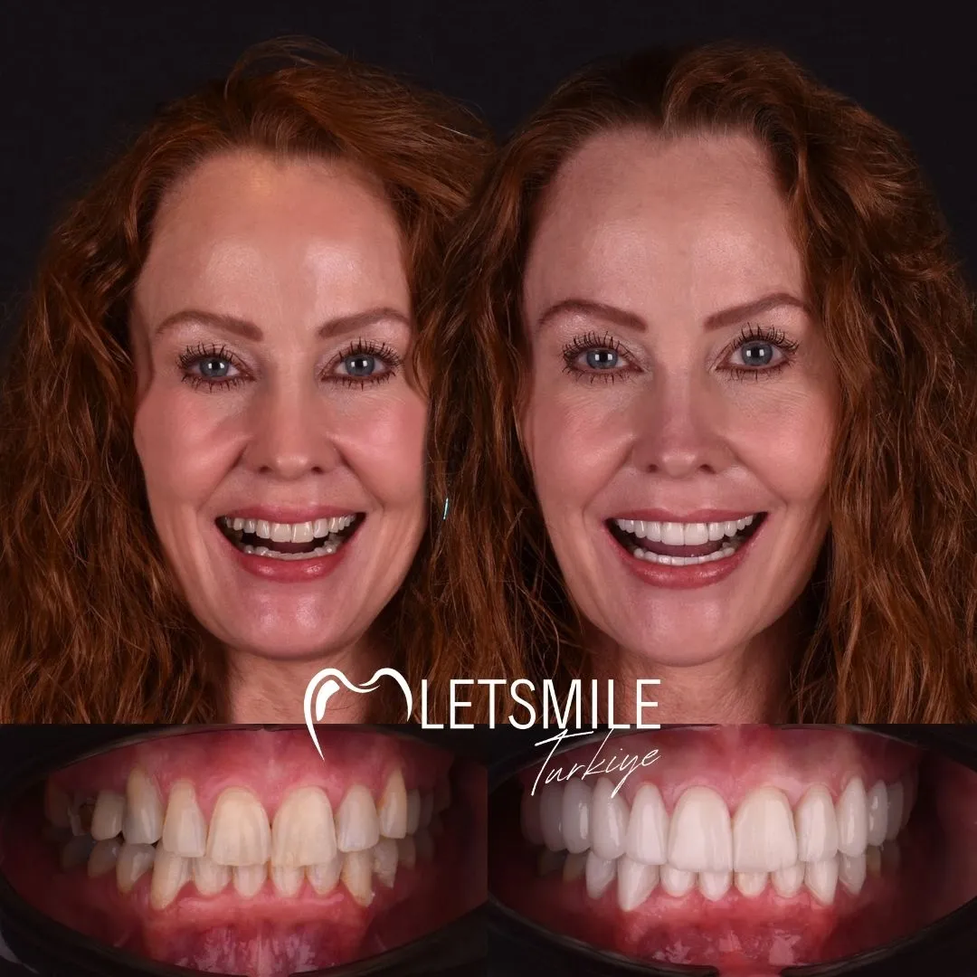 Zirconium Crowns antalya turkey