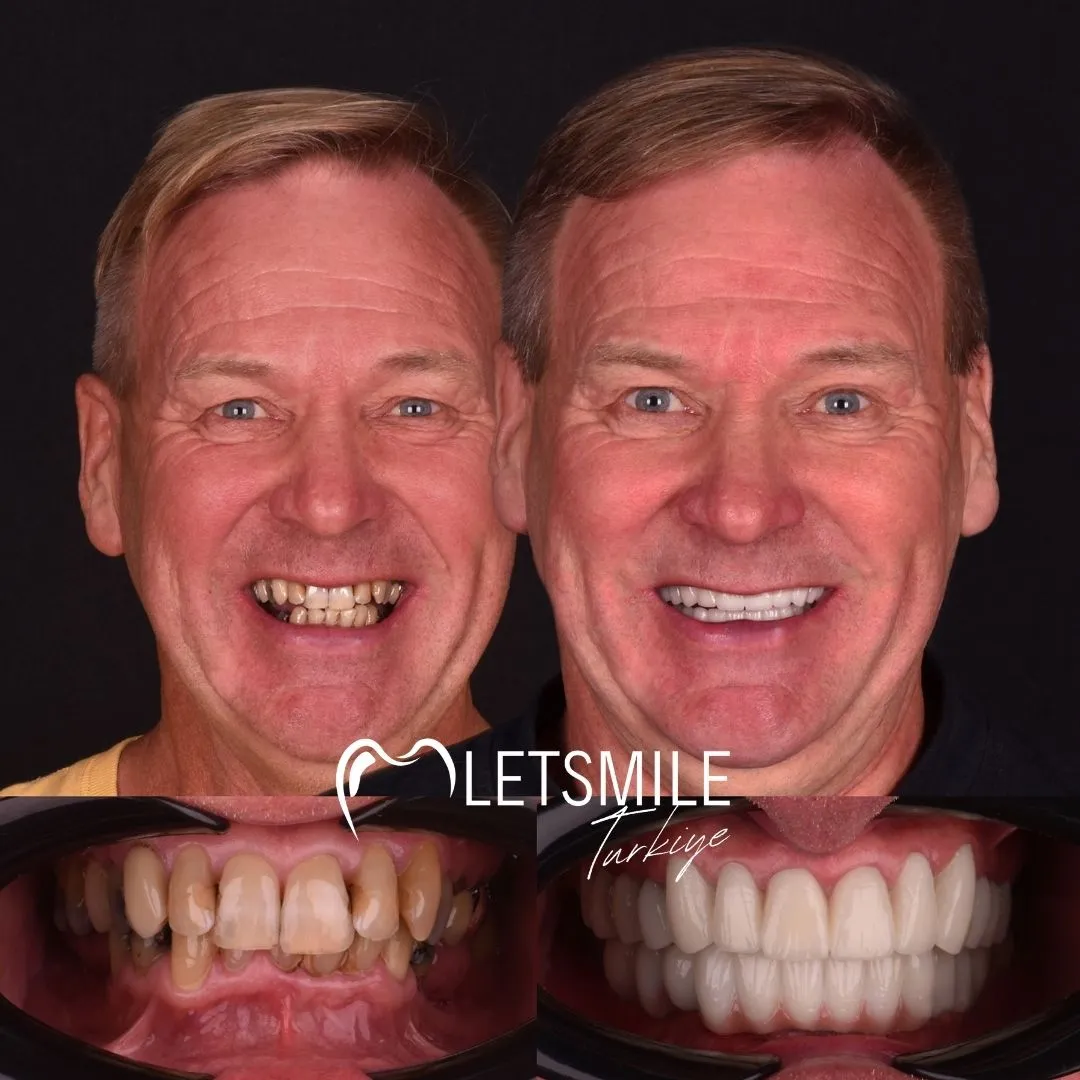 turkey teeth before and after photos