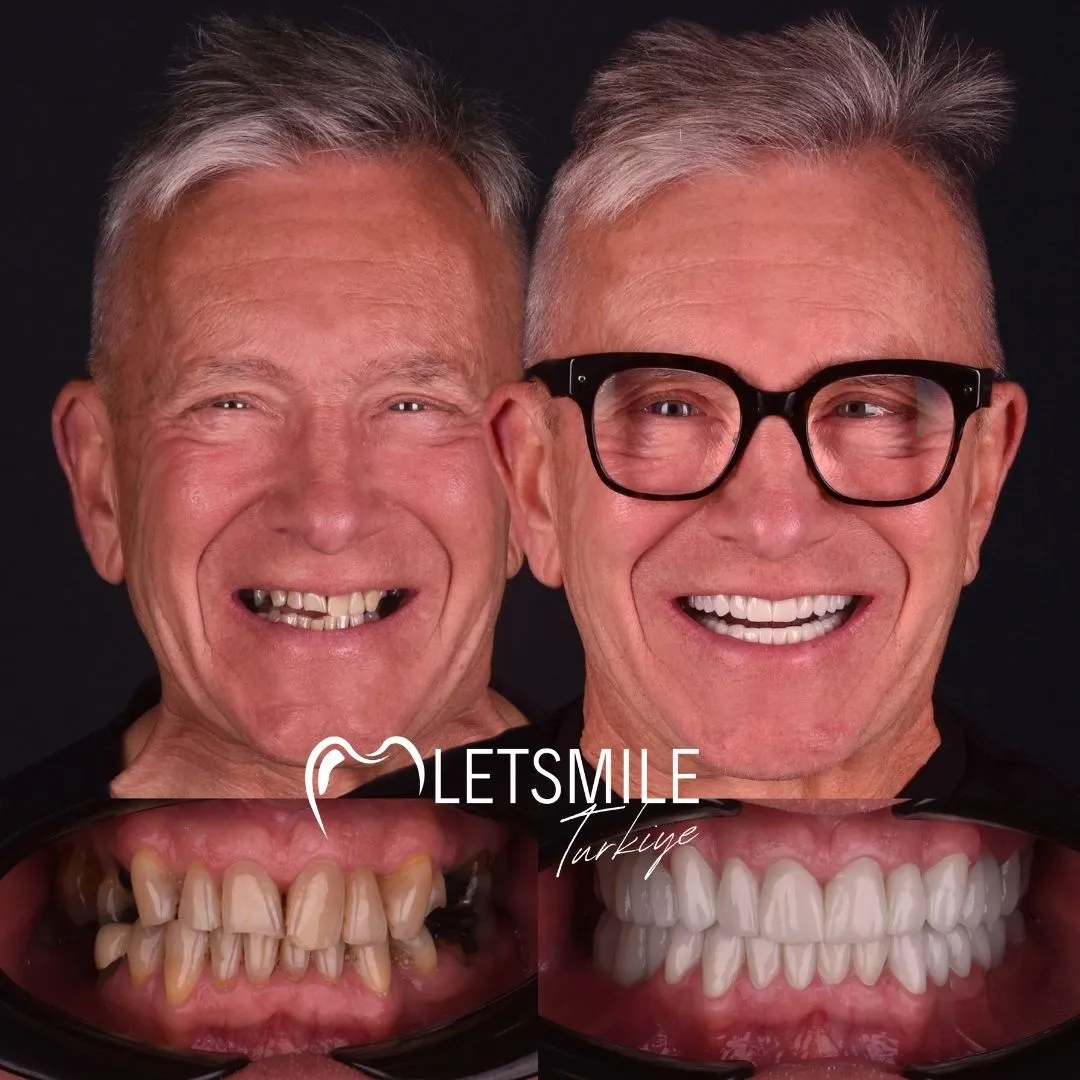 before after teeth pictures