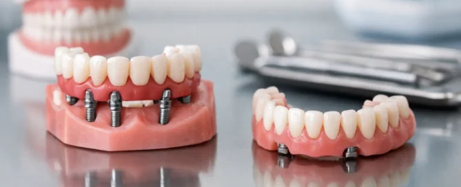 Does All-on-4 Include Temporary Teeth in Turkey? 9 Does All-on-4 Include Temporary Teeth in Turkey?